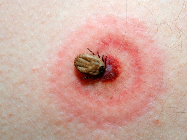 Lyme-Borreliose: Die Geister- Bedrohung