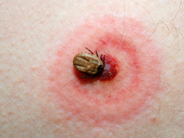 Lyme Disease: The Ghost Threat